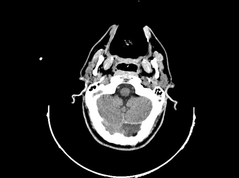 File:Brain injury by firearm projectile (Radiopaedia 82068-96088 A 67).jpg