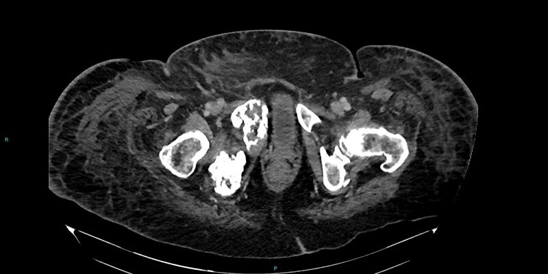 File:Breast cancer pelvic bony metastases (Radiopaedia 84470-99824 Axial bone window 65).jpg