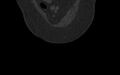 Breast carcinoma with pathological hip fracture (Radiopaedia 60314-67993 Coronal bone window 27).jpg