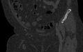 Breast carcinoma with pathological hip fracture (Radiopaedia 60314-67993 Coronal bone window 52).jpg