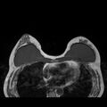 Breast implants - MRI (Radiopaedia 26864-27035 Axial T1 25).jpg