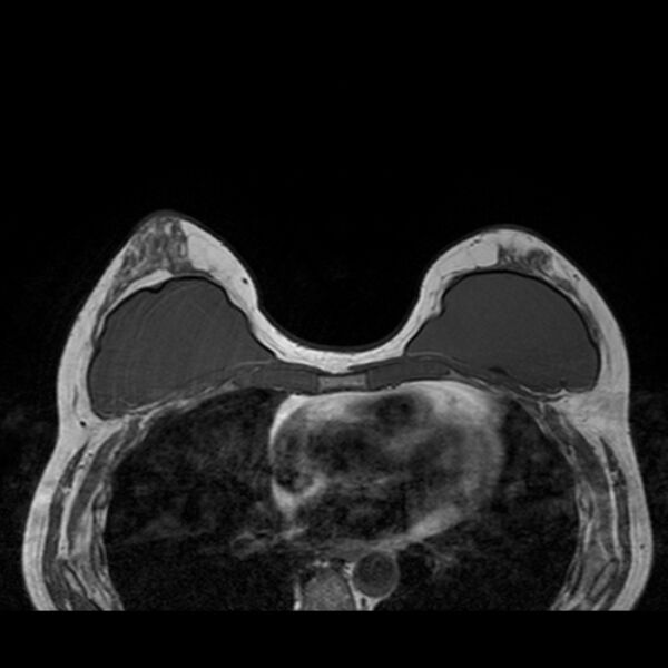 File:Breast implants - MRI (Radiopaedia 26864-27035 Axial T1 25).jpg