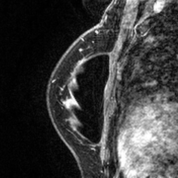 File:Breast implants - MRI (Radiopaedia 26864-27035 Sagittal T2 42).jpg