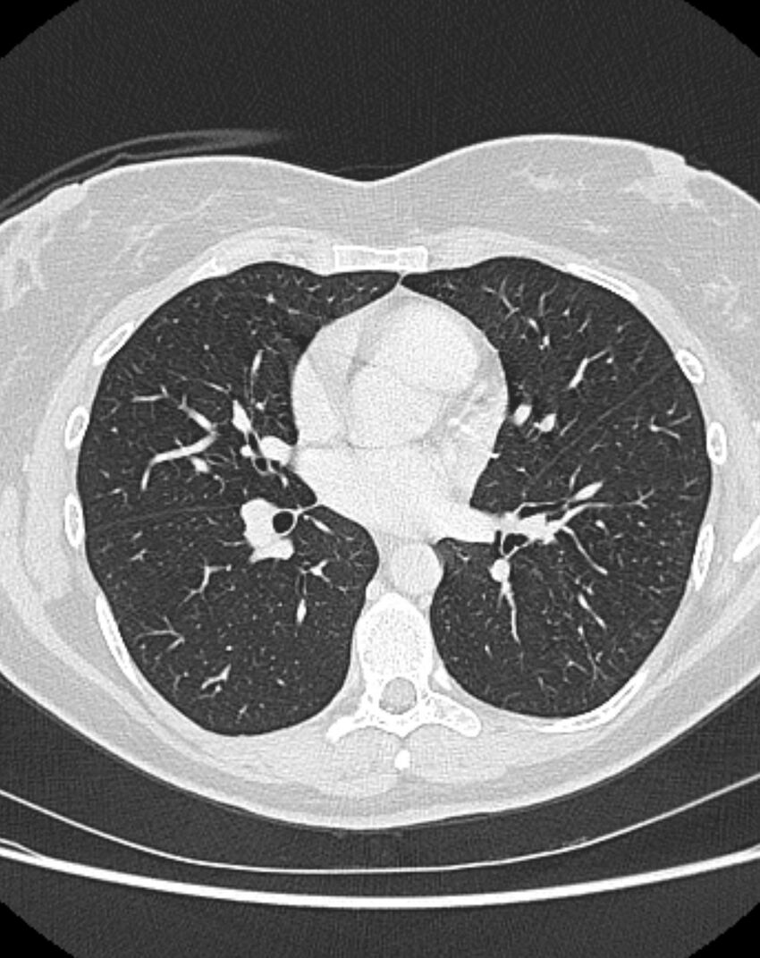 Bronchial atresia (Radiopaedia 50007-55297 Axial lung window 57).jpg