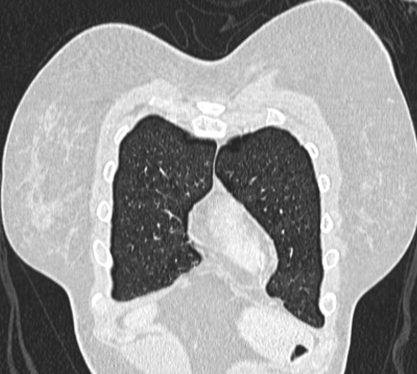 Bronchial atresia (Radiopaedia 50007-55297 Coronal lung window 7).jpg