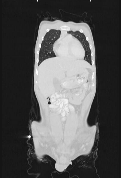 File:Bronchial carcinoid tumor (Radiopaedia 57187-64090 Coronal lung window 16).jpg