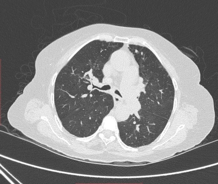 Bronchiectasis (Radiopaedia 72693-83293 Axial lung window 53).jpg