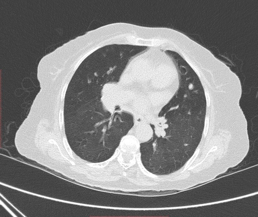 Bronchiectasis (Radiopaedia 72693-83293 Axial lung window 68).jpg