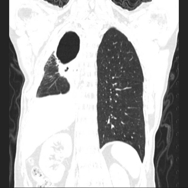File:Bronchopleural fistula - postoperative complication (Radiopaedia 21020-20947 Coronal lung window 20).jpg