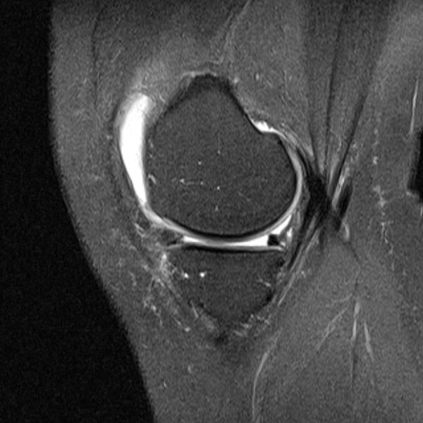 File:Bucket handle tear - medial meniscus (Radiopaedia 79028-91942 Sagittal PD fat sat 19).jpg