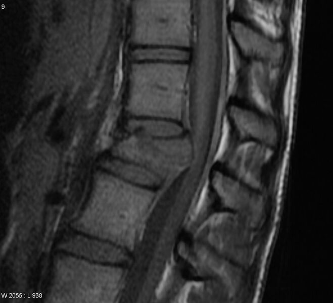 File:Burst lumbar fracture (Radiopaedia 4635-6718 Sagittal T1 1).jpg