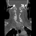 C1 anterior arch (plough) fracture - type 1 (Radiopaedia 76181-87720 Coronal bone window 47).jpg