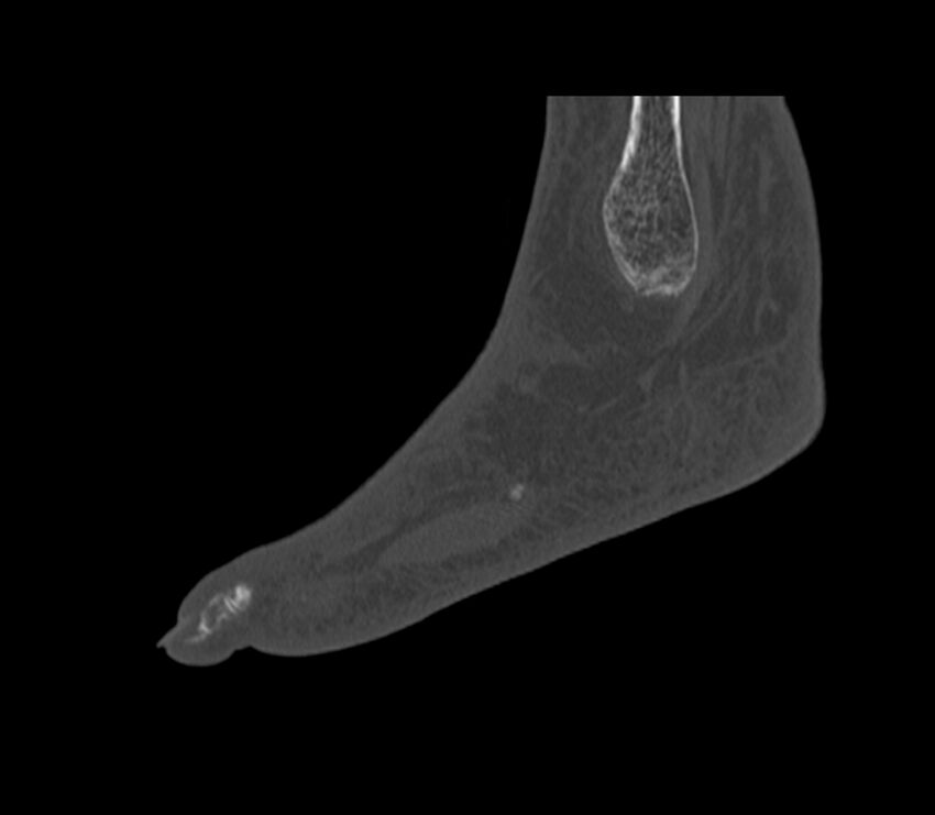 Calcaneal tuberosity avulsion fracture (Radiopaedia 22649-22668 Sagittal bone window 6).jpg