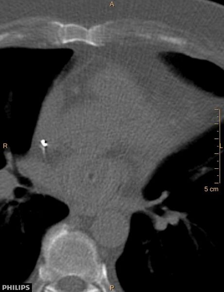File:Calcified cardiac fibroma (Radiopaedia 39267-41519 Axial bone window 11).jpg