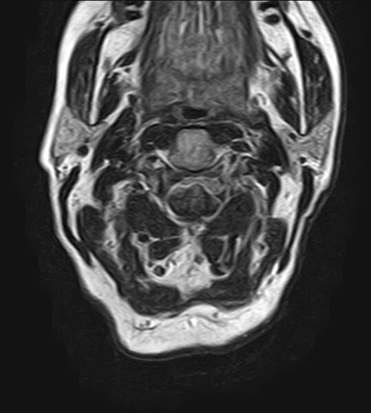File:Calcified meningioma - cervical canal (Radiopaedia 70136-82468 Axial T2 9).jpg