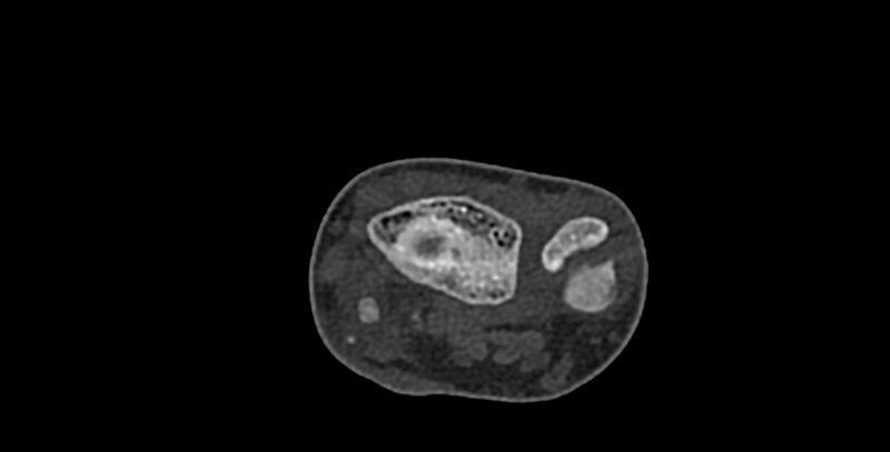 File:Calcifying aponeurotic fibroma (Radiopaedia 88423-105064 Axial bone window 36).jpg