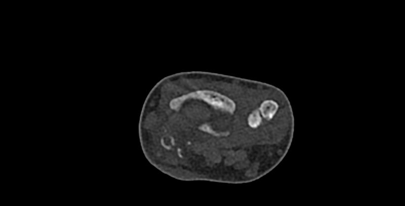 File:Calcifying aponeurotic fibroma (Radiopaedia 88423-105064 Axial bone window 39).jpg