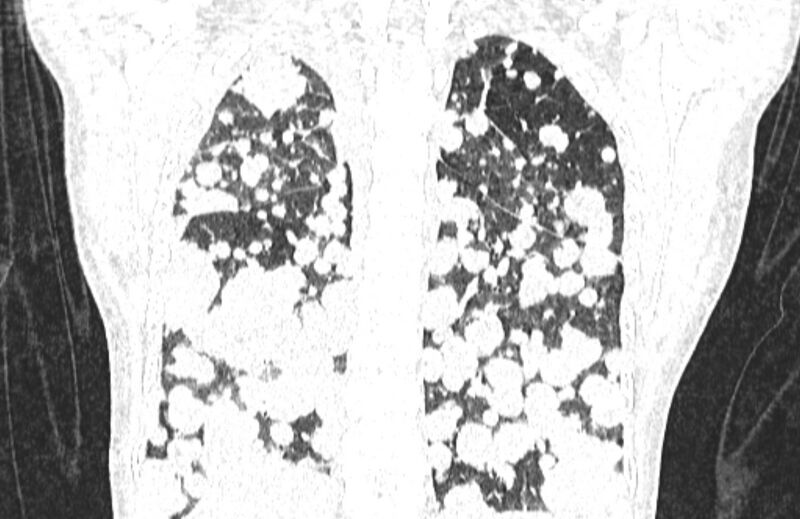 File:Cannonball metastases from breast cancer (Radiopaedia 91024-108569 Coronal lung window 109).jpg