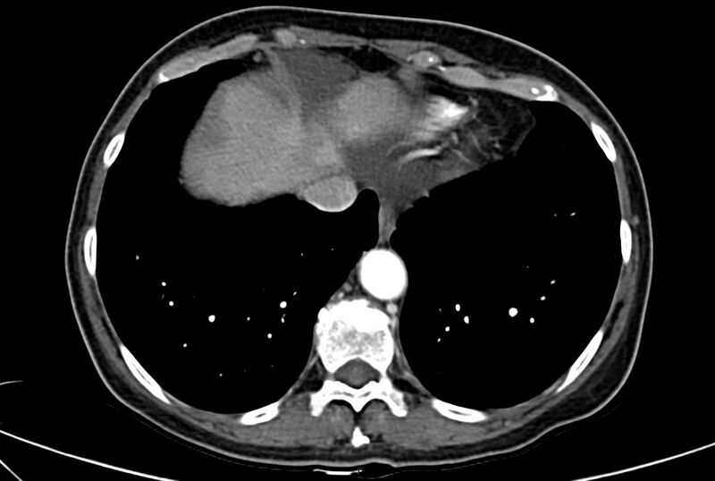 File:Carcinoid mesenteric tumor complicated by chylous ascites (Radiopaedia 76312-88926 A 4).jpg
