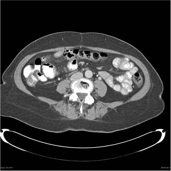 File:Carcinoid tumor of the ileum with metastasis to orbit (Radiopaedia 28165-28425 A 10).jpg