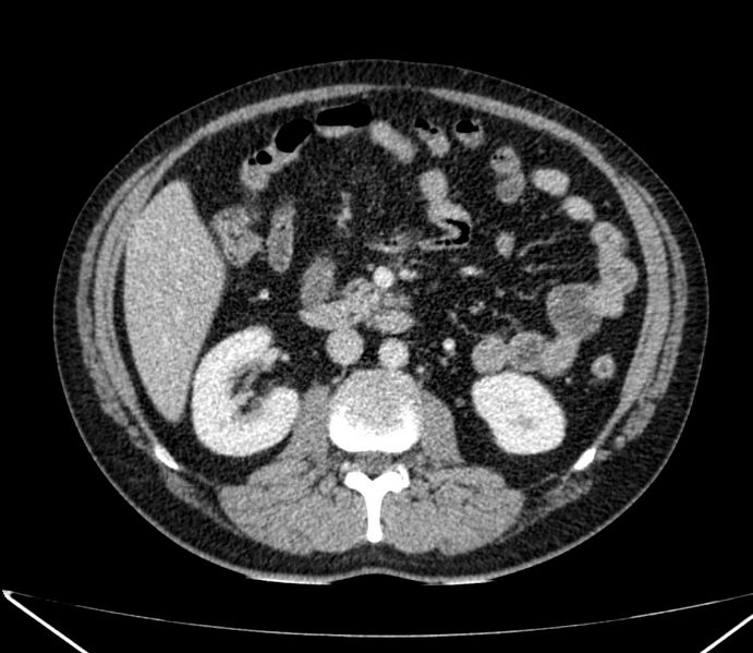 File:Carcinoid tumor with hepatic metastases (Radiopaedia 22651-22670 C 48).jpg