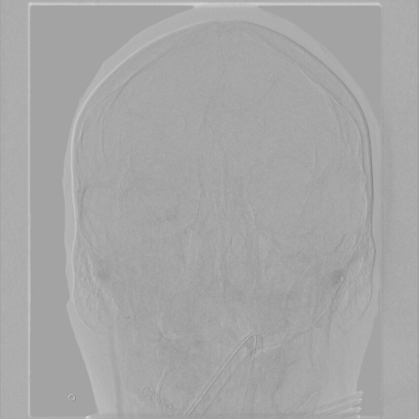 Caroticocavernous fistula - direct (Radiopaedia 61660-69666 A 46).jpg