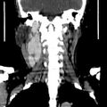 Carotid body tumor (Radiopaedia 27890-28124 B 6).jpg