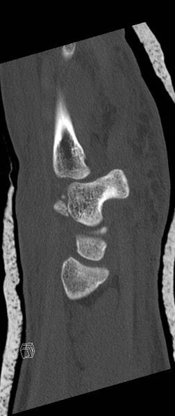 File:Carpal fractures (smart watch impaction) (Radiopaedia 55844-62430 Sagittal bone window 15).jpg