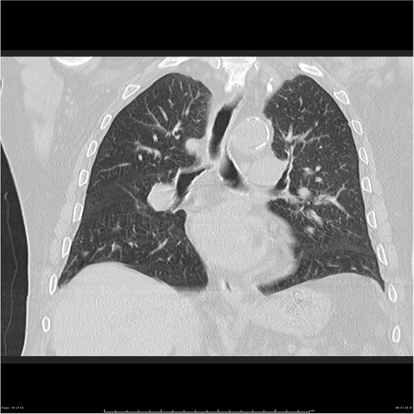 File:Cavitating left lower lobe lesion - squamous cell lung cancer (Radiopaedia 27749-28176 Coronal lung window 30).jpg