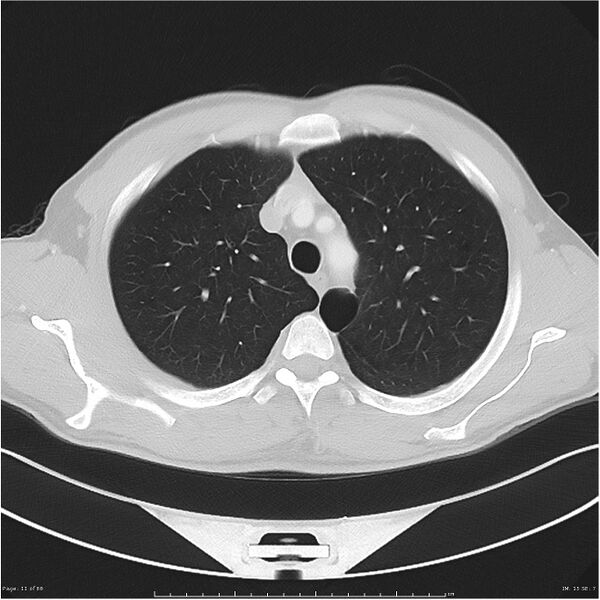 File:Cavitating lung cancer (Radiopaedia 25796-25945 Axial lung window 11).jpg