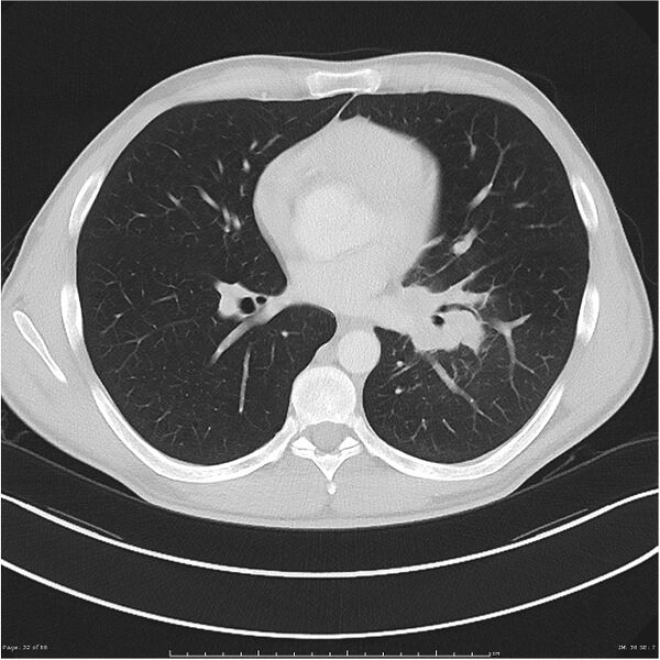 File:Cavitating lung cancer (Radiopaedia 25796-25945 Axial lung window 32).jpg