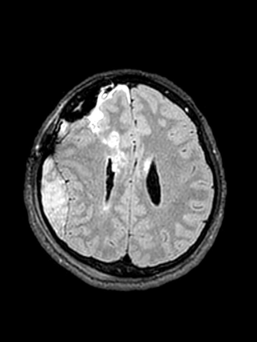 Central neurocytoma (Radiopaedia 79320-92381 Axial FLAIR 61).jpg