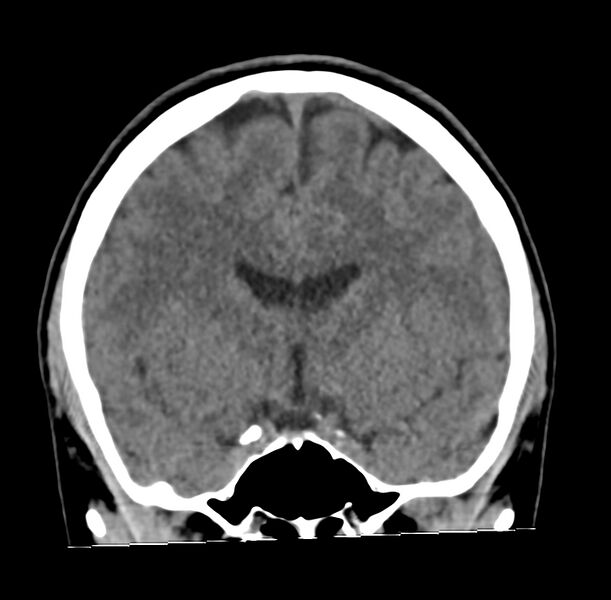 File:Cerebellar agenesis (Radiopaedia 30203-30817 Coronal non-contrast 13).jpg