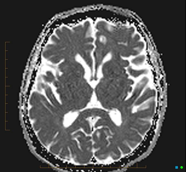 File:Cerebellar gangliocytoma (Radiopaedia 65377-74422 Axial ADC 20).jpg