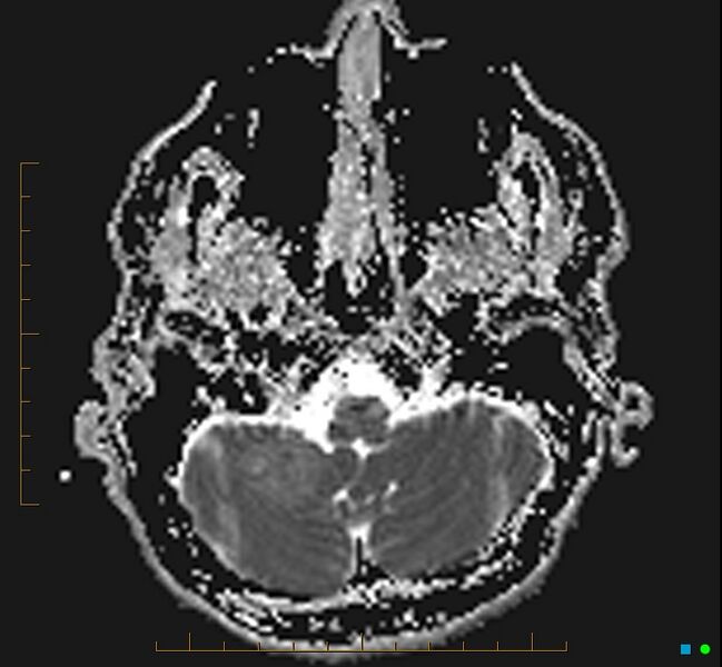 File:Cerebellar gangliocytoma (Radiopaedia 65377-74422 Axial ADC 6).jpg