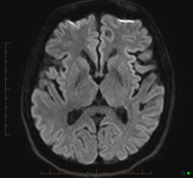 File:Cerebellar gangliocytoma (Radiopaedia 65377-74422 Axial DWI 20).jpg