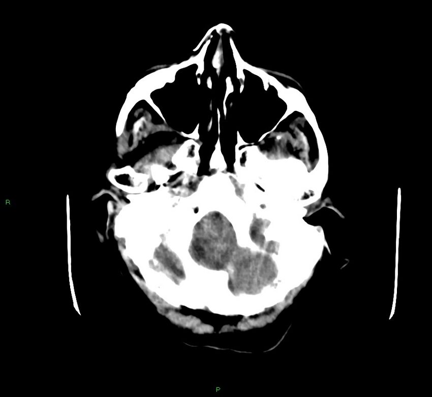 Cerebellar hemorrhage (Radiopaedia 58792-66026 Axial non-contrast 44).jpg
