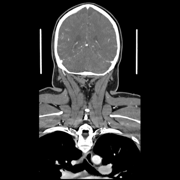 File:Cerebellar infarct due to vertebral artery dissection with posterior fossa decompression (Radiopaedia 82779-97029 D 46).png