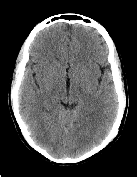 File:Cerebellar infarct due to vertebral artery dissection with posterior fossa decompression (Radiopaedia 82779-97030 Axial non-contrast 16).png