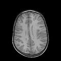 Cerebral abscess post cardiac surgery (Radiopaedia 27244-27420 Axial T1 17).jpg