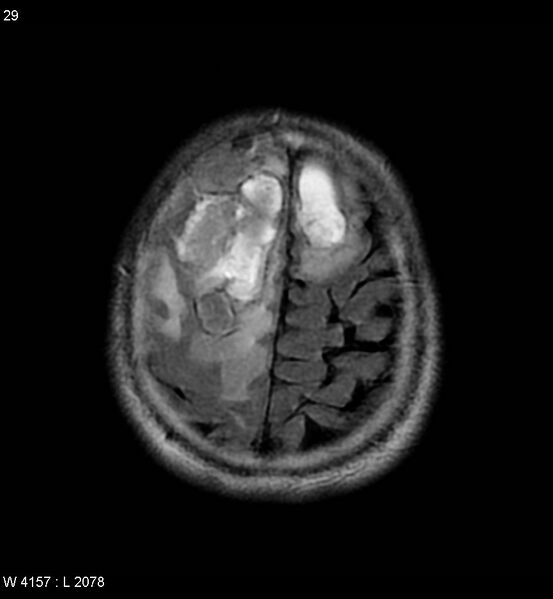 File:Cerebral abscesses secondary to contusions (Radiopaedia 5201-6968 Axial FLAIR 8).jpg