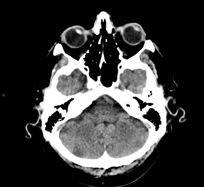 File:Cerebral amyloid angiopathy-associated lobar intracerebral hemorrhage (Radiopaedia 58376-65511 Axial non-contrast 44).jpg