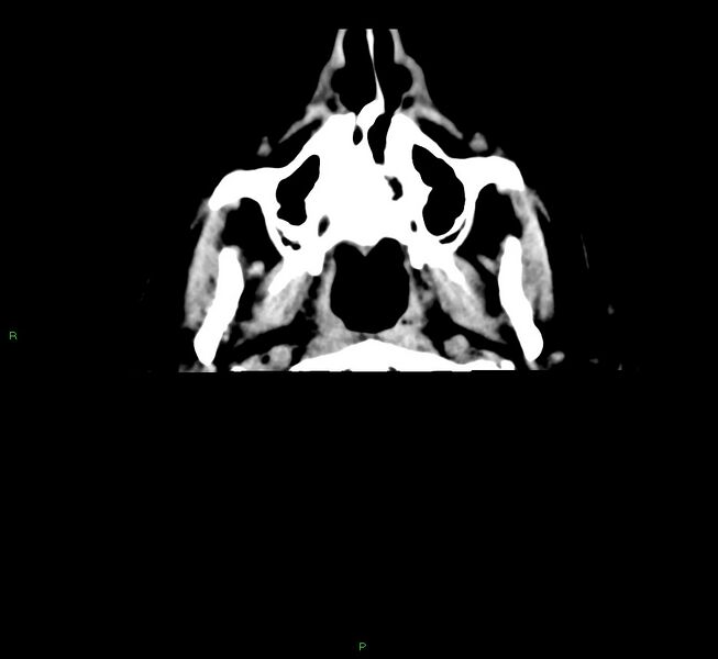File:Cerebral amyloid angiopathy-associated lobar intracerebral hemorrhage (Radiopaedia 58376-65511 Axial non-contrast 56).jpg