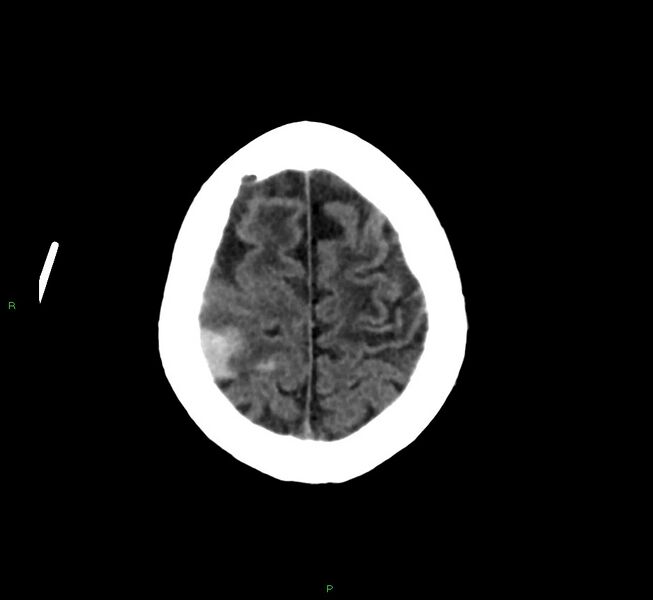 File:Cerebral amyloid angiopathy-associated lobar intracerebral hemorrhage (Radiopaedia 58376-65513 Axial non-contrast 10).jpg