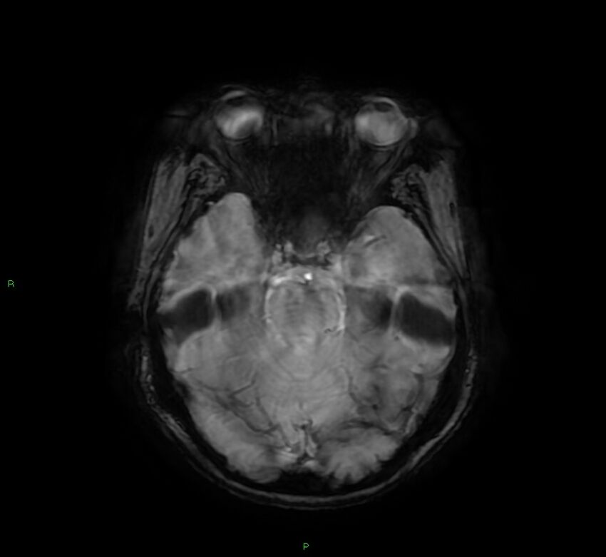 Cerebral amyloid angiopathy-associated lobar intracerebral hemorrhage (Radiopaedia 58378-65517 Axial SWI 24).jpg