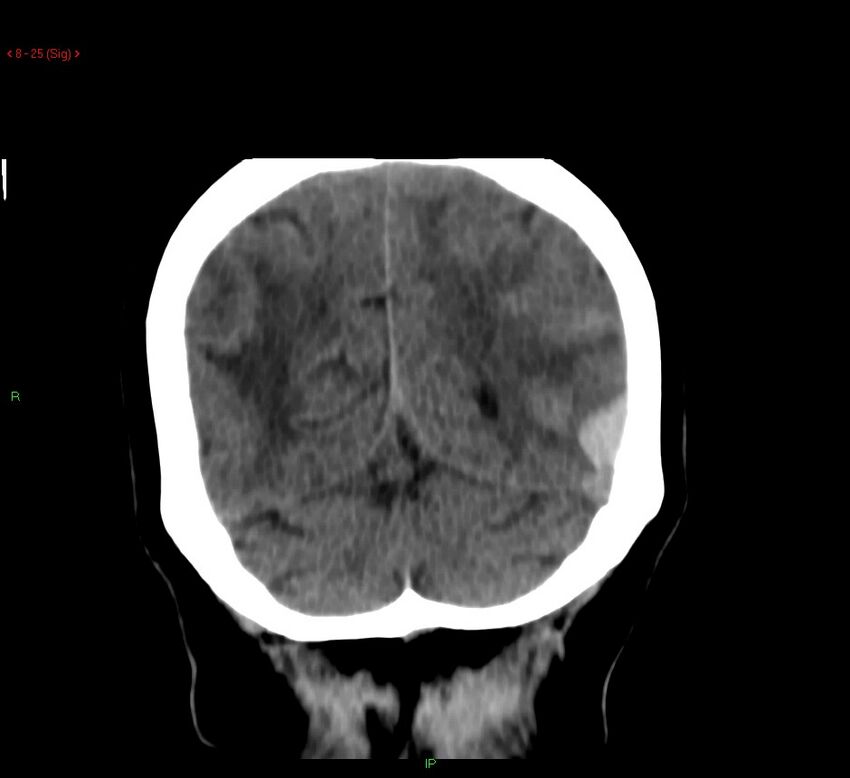 Cerebral amyloid angiopathy-associated lobar intracerebral hemorrhage (Radiopaedia 58378-65518 Coronal non-contrast 25).jpg