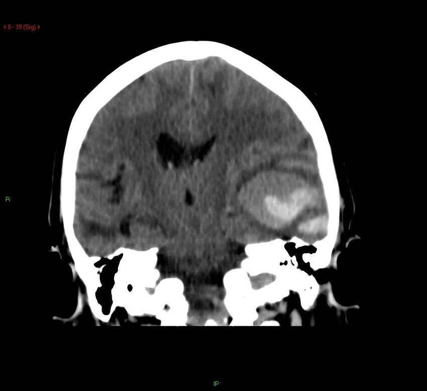 Cerebral amyloid angiopathy-associated lobar intracerebral hemorrhage (Radiopaedia 58378-65518 Coronal non-contrast 39).jpg