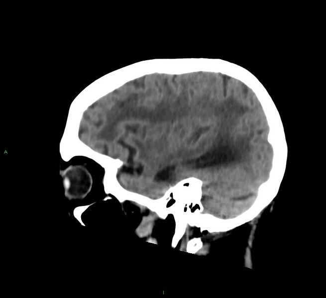 File:Cerebral amyloid angiopathy-associated lobar intracerebral hemorrhage (Radiopaedia 58530-65688 C 15).jpg