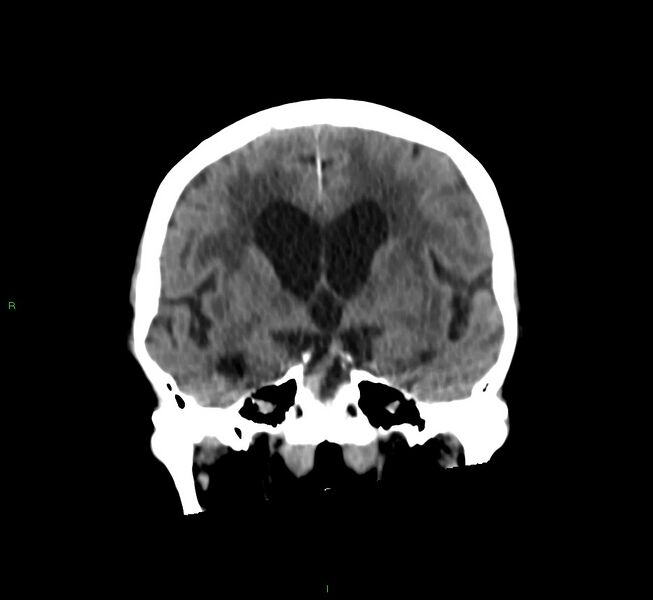 File:Cerebral amyloid angiopathy-associated lobar intracerebral hemorrhage (Radiopaedia 58530-65688 Coronal non-contrast 39).jpg