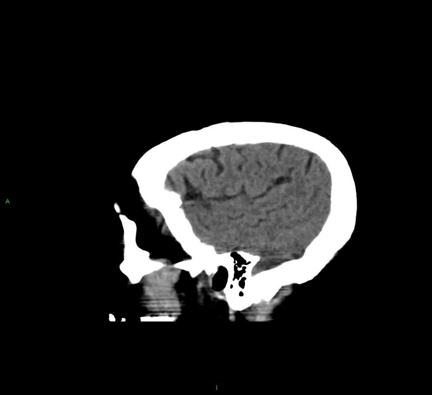 Cerebral amyloid angiopathy-associated lobar intracerebral hemorrhage (Radiopaedia 58560-65723 C 44).jpg